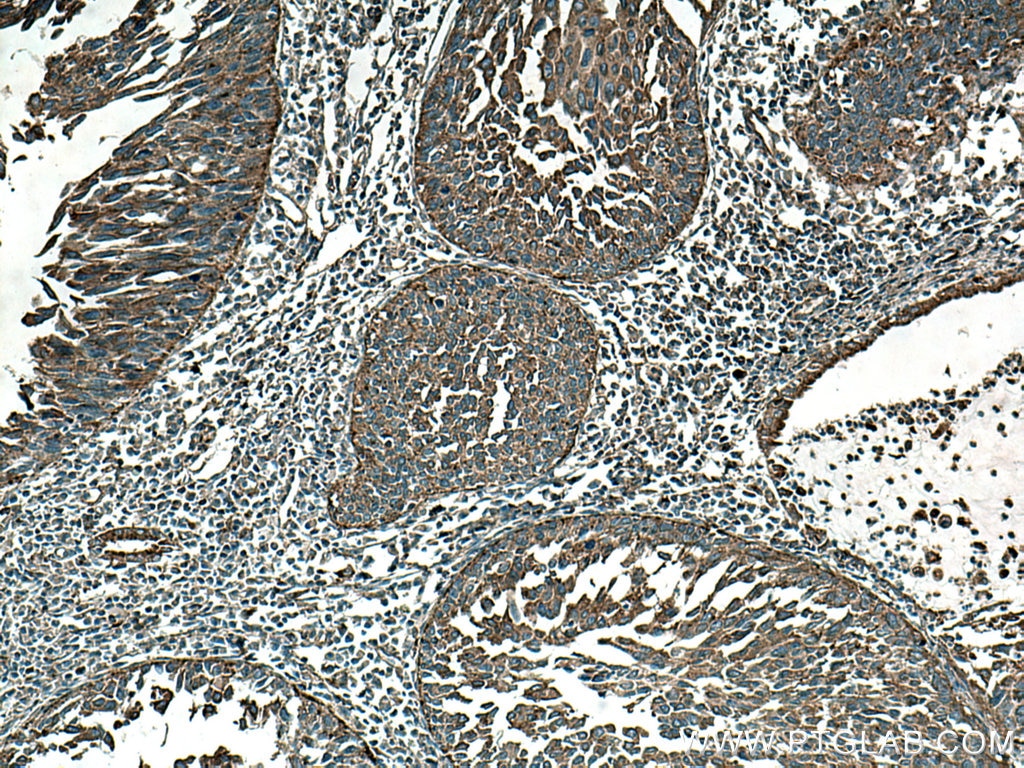Immunohistochemistry (IHC) staining of human cervical cancer tissue using BSEP Monoclonal antibody (67512-1-Ig)