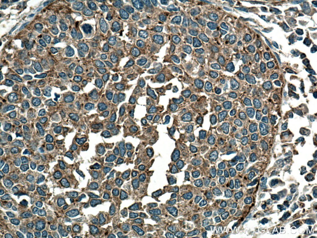 Immunohistochemistry (IHC) staining of human cervical cancer tissue using BSEP Monoclonal antibody (67512-1-Ig)