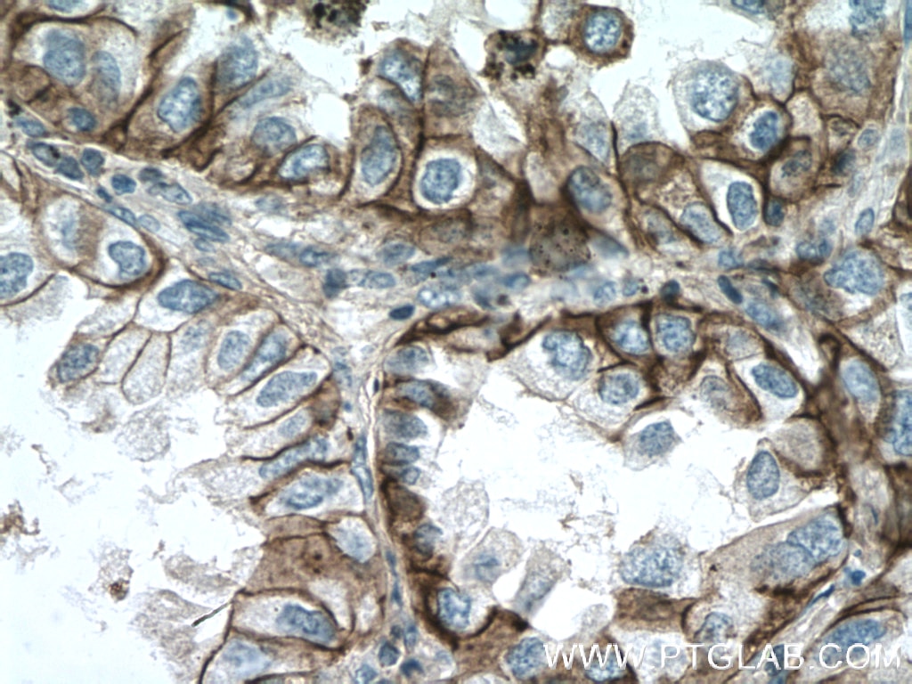 Immunohistochemistry (IHC) staining of human lung cancer tissue using CD147 Polyclonal antibody (11989-1-AP)