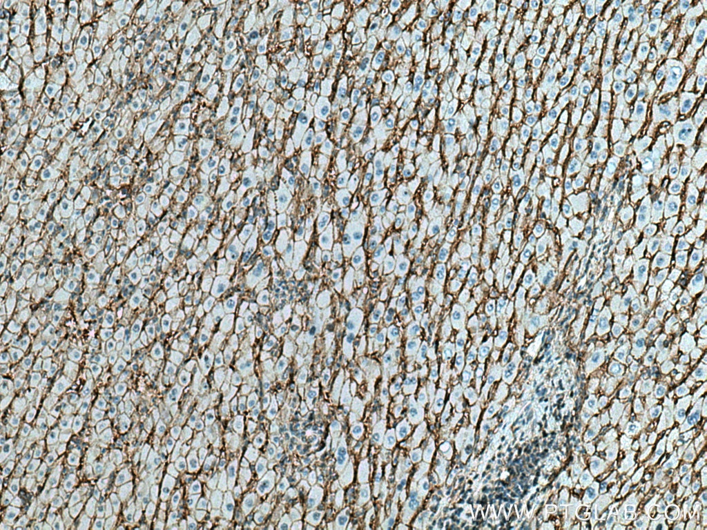 Immunohistochemistry (IHC) staining of human liver cancer tissue using CD147 Polyclonal antibody (11989-1-AP)