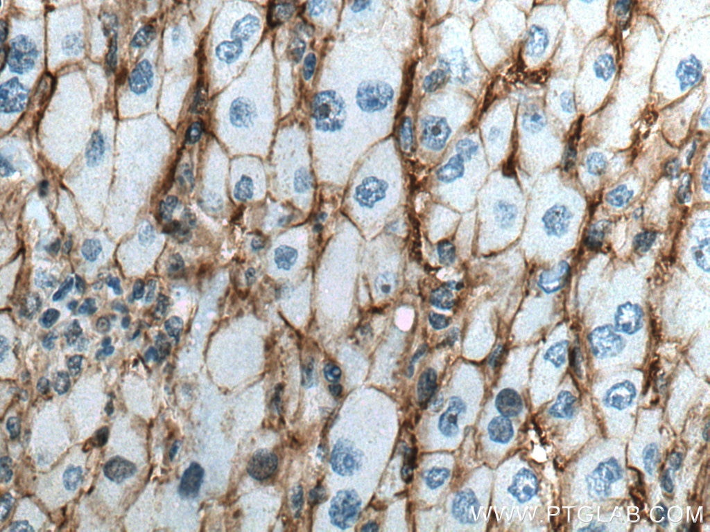 Immunohistochemistry (IHC) staining of human liver cancer tissue using CD147 Polyclonal antibody (11989-1-AP)