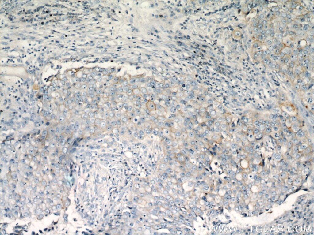 Immunohistochemistry (IHC) staining of human breast cancer tissue using CD147 Polyclonal antibody (11989-1-AP)