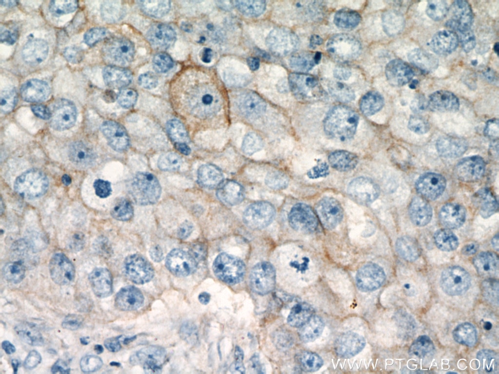 Immunohistochemistry (IHC) staining of human breast cancer tissue using CD147 Polyclonal antibody (11989-1-AP)