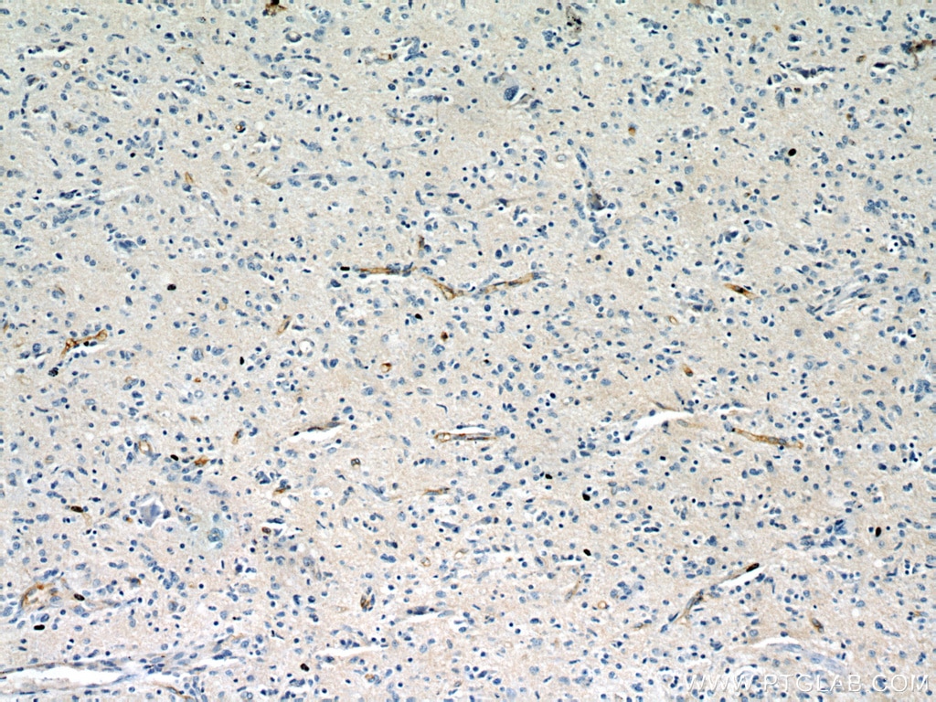 Immunohistochemistry (IHC) staining of human gliomas tissue using CD147 Polyclonal antibody (11989-1-AP)