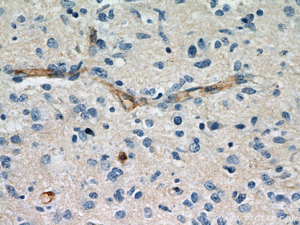 Immunohistochemistry (IHC) staining of human gliomas tissue using CD147 Polyclonal antibody (11989-1-AP)