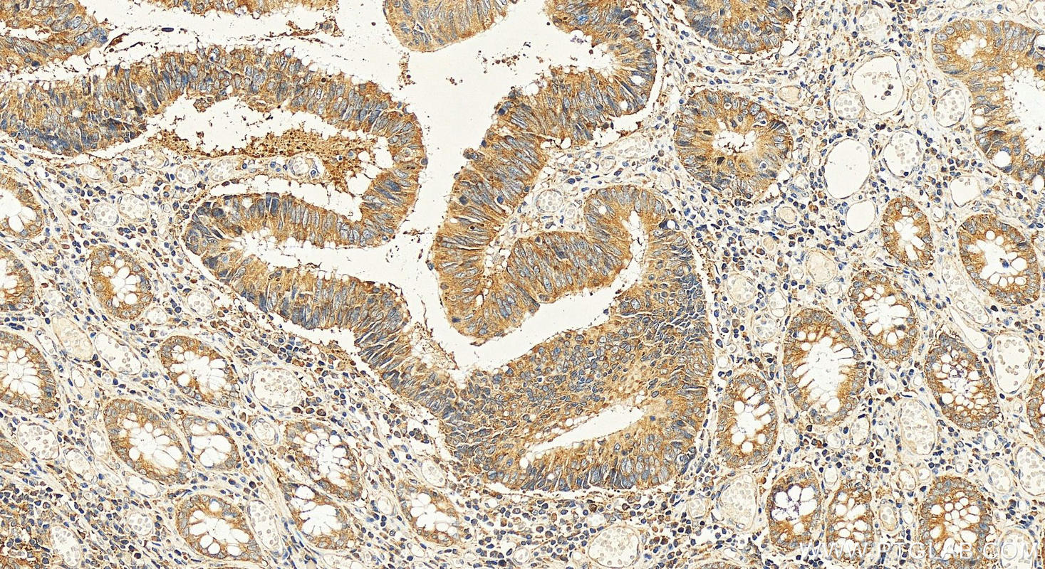Immunohistochemistry (IHC) staining of human colon cancer tissue using BTF3 Polyclonal antibody (15415-1-AP)