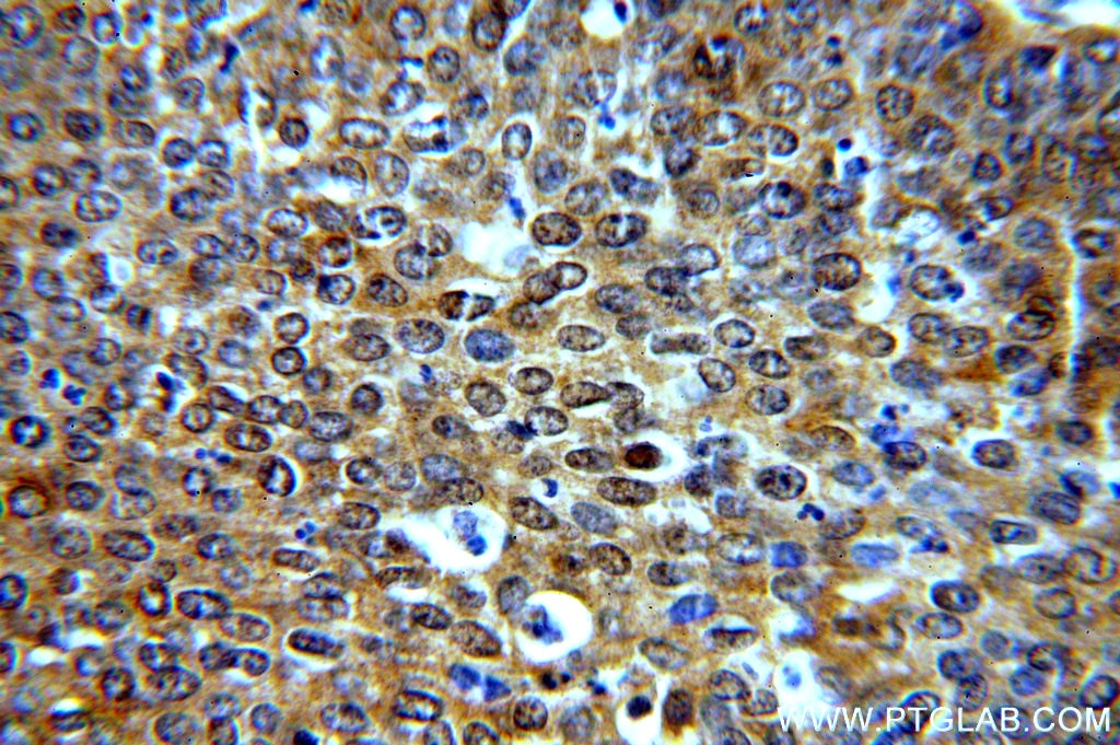 IHC staining of human cervical cancer using 19753-1-AP