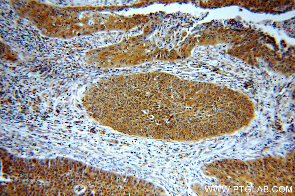 IHC staining of human cervical cancer using 19753-1-AP