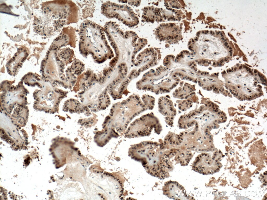 Immunohistochemistry (IHC) staining of human thyroid cancer tissue using BTG1 Polyclonal antibody (14879-1-AP)