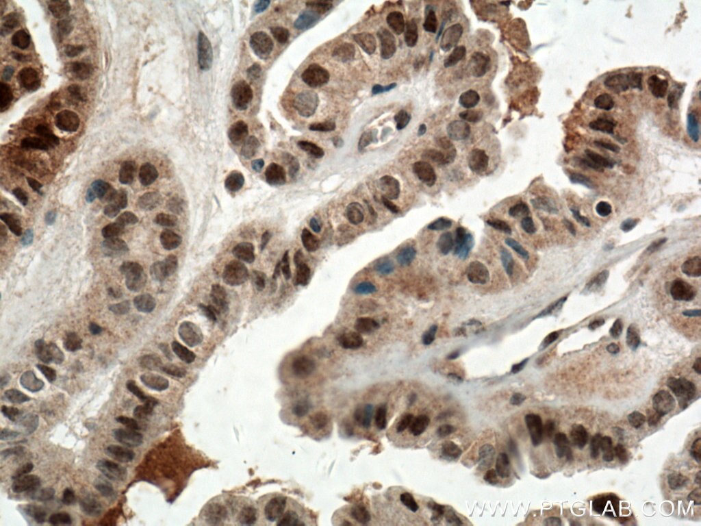 Immunohistochemistry (IHC) staining of human thyroid cancer tissue using BTG1 Polyclonal antibody (14879-1-AP)