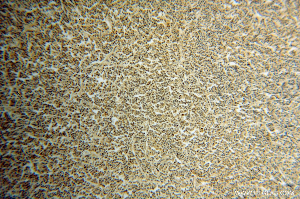 IHC staining of human lymphoma using 14879-1-AP