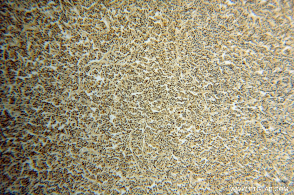 Immunohistochemistry (IHC) staining of human lymphoma tissue using BTG1 Polyclonal antibody (14879-1-AP)