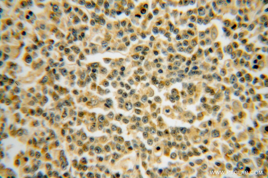 Immunohistochemistry (IHC) staining of human lymphoma tissue using BTG1 Polyclonal antibody (14879-1-AP)