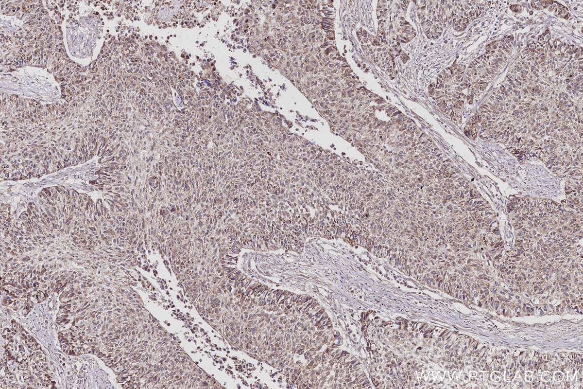 Immunohistochemistry (IHC) staining of human lung cancer tissue using BTG4 Polyclonal antibody (20514-1-AP)
