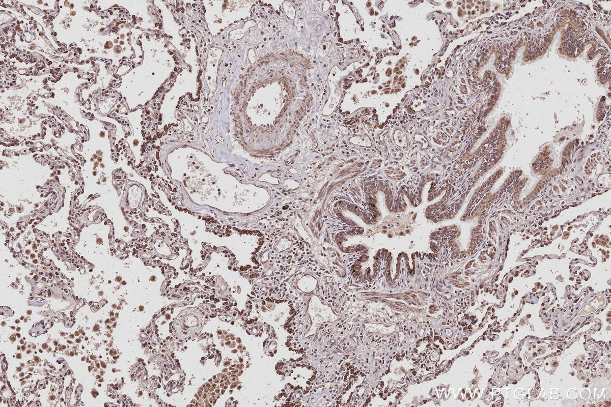 Immunohistochemistry (IHC) staining of human lung cancer tissue using BTG4 Polyclonal antibody (20514-1-AP)