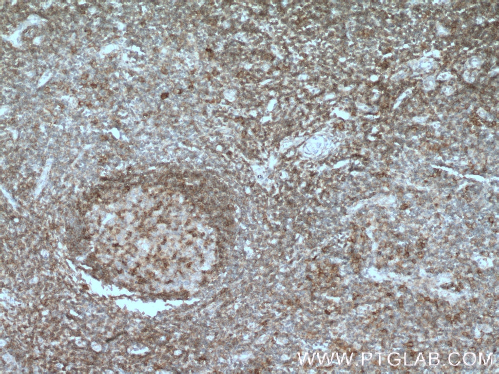 Immunohistochemistry (IHC) staining of human tonsillitis tissue using BTLA Polyclonal antibody (21300-1-AP)