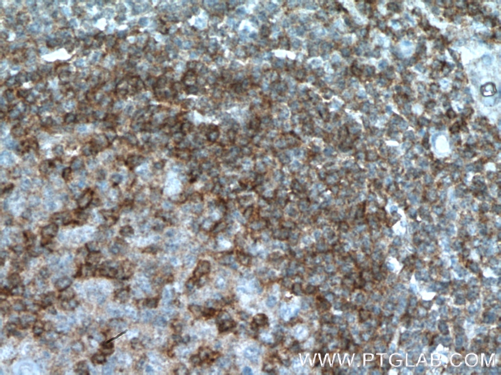 Immunohistochemistry (IHC) staining of human tonsillitis tissue using BTLA Polyclonal antibody (21300-1-AP)