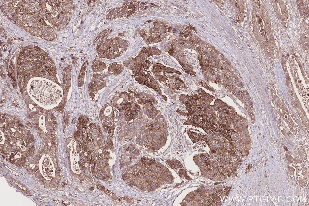 Immunohistochemistry (IHC) staining of human stomach cancer tissue using BTN2A2 Polyclonal antibody (16482-1-AP)