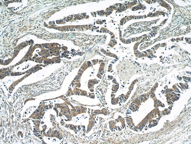 Immunohistochemistry (IHC) staining of human colon cancer tissue using BubR1 Polyclonal antibody (11504-2-AP)