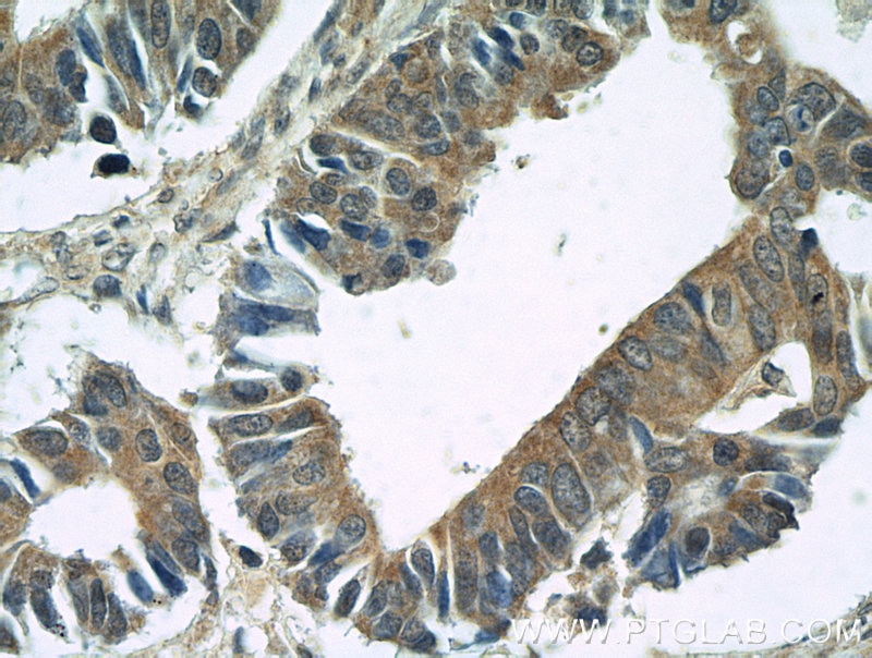Immunohistochemistry (IHC) staining of human colon cancer tissue using BubR1 Polyclonal antibody (11504-2-AP)