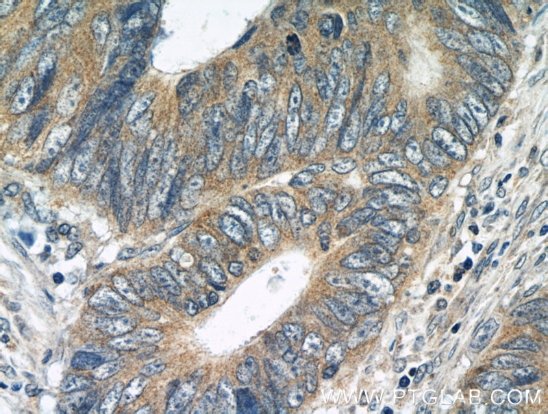 Immunohistochemistry (IHC) staining of human colon cancer tissue using BubR1 Polyclonal antibody (11504-2-AP)