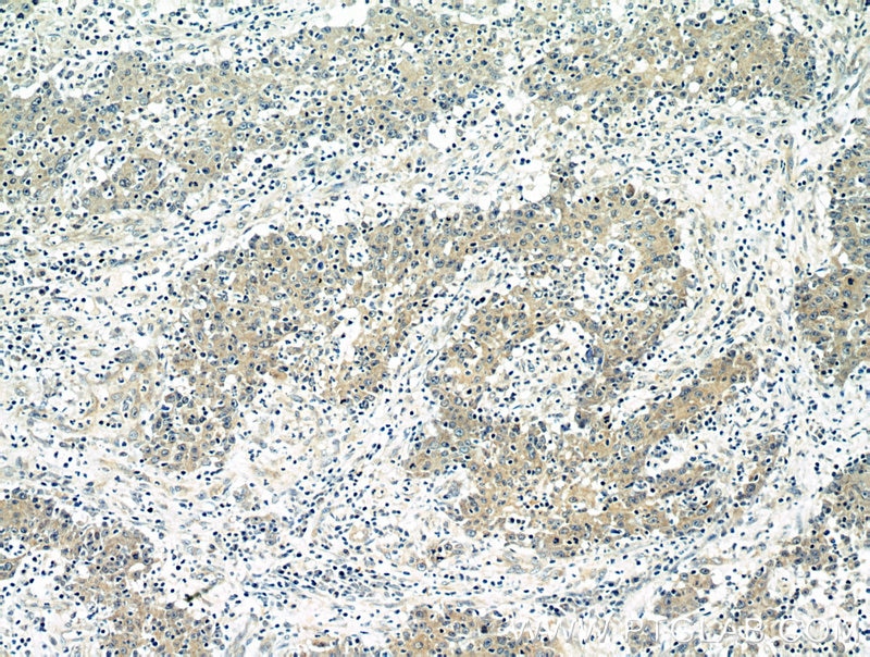 Immunohistochemistry (IHC) staining of human colon cancer tissue using BubR1 Polyclonal antibody (11504-2-AP)