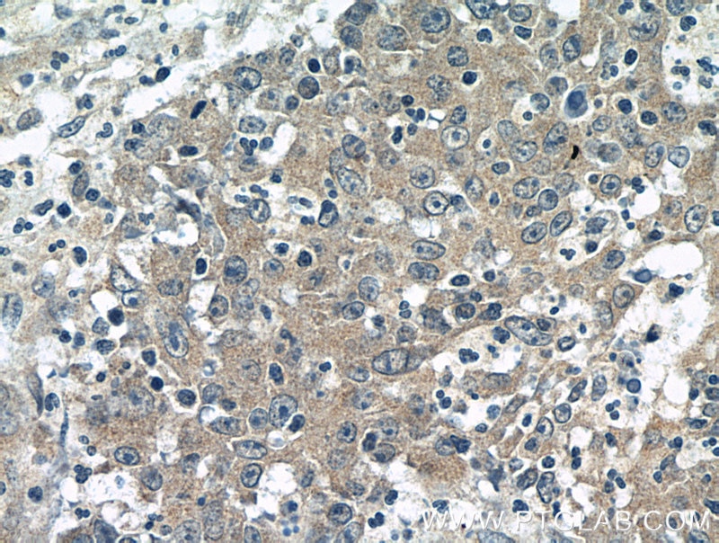 Immunohistochemistry (IHC) staining of human colon cancer tissue using BubR1 Polyclonal antibody (11504-2-AP)