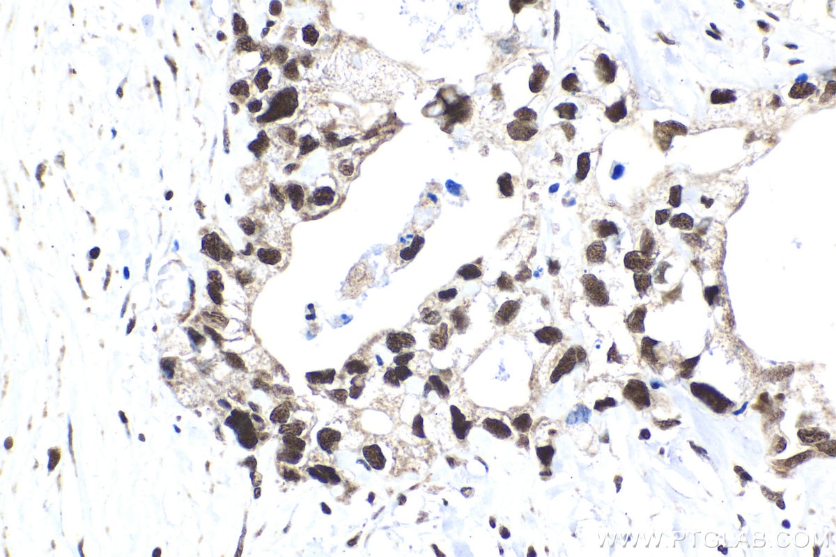Immunohistochemistry (IHC) staining of human pancreas cancer tissue using BUB3 Polyclonal antibody (27073-1-AP)