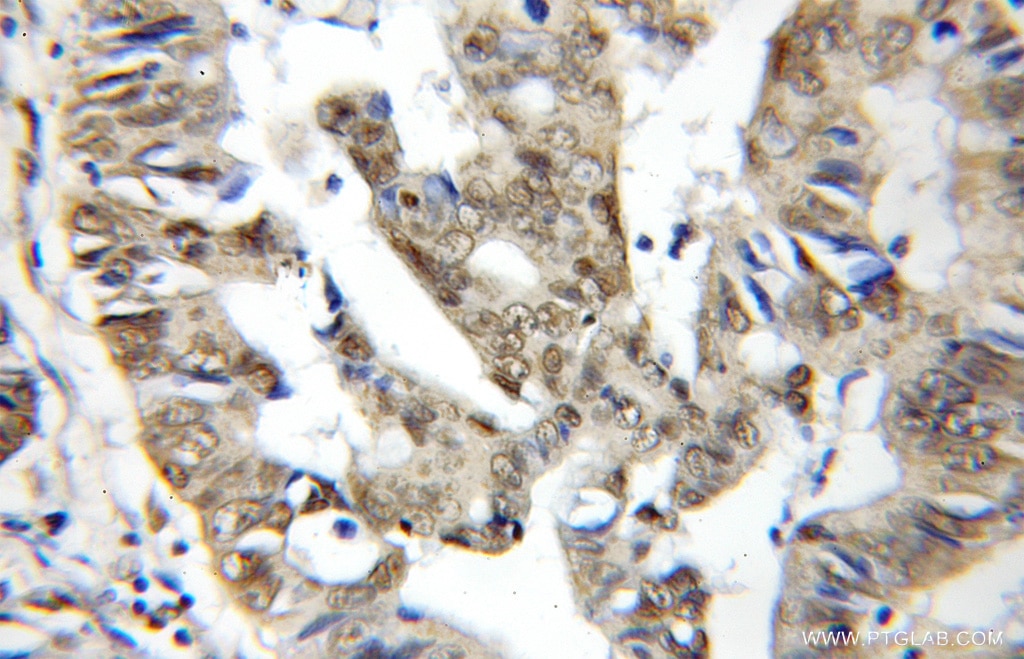 Immunohistochemistry (IHC) staining of human colon cancer tissue using BUD31 Polyclonal antibody (11798-1-AP)