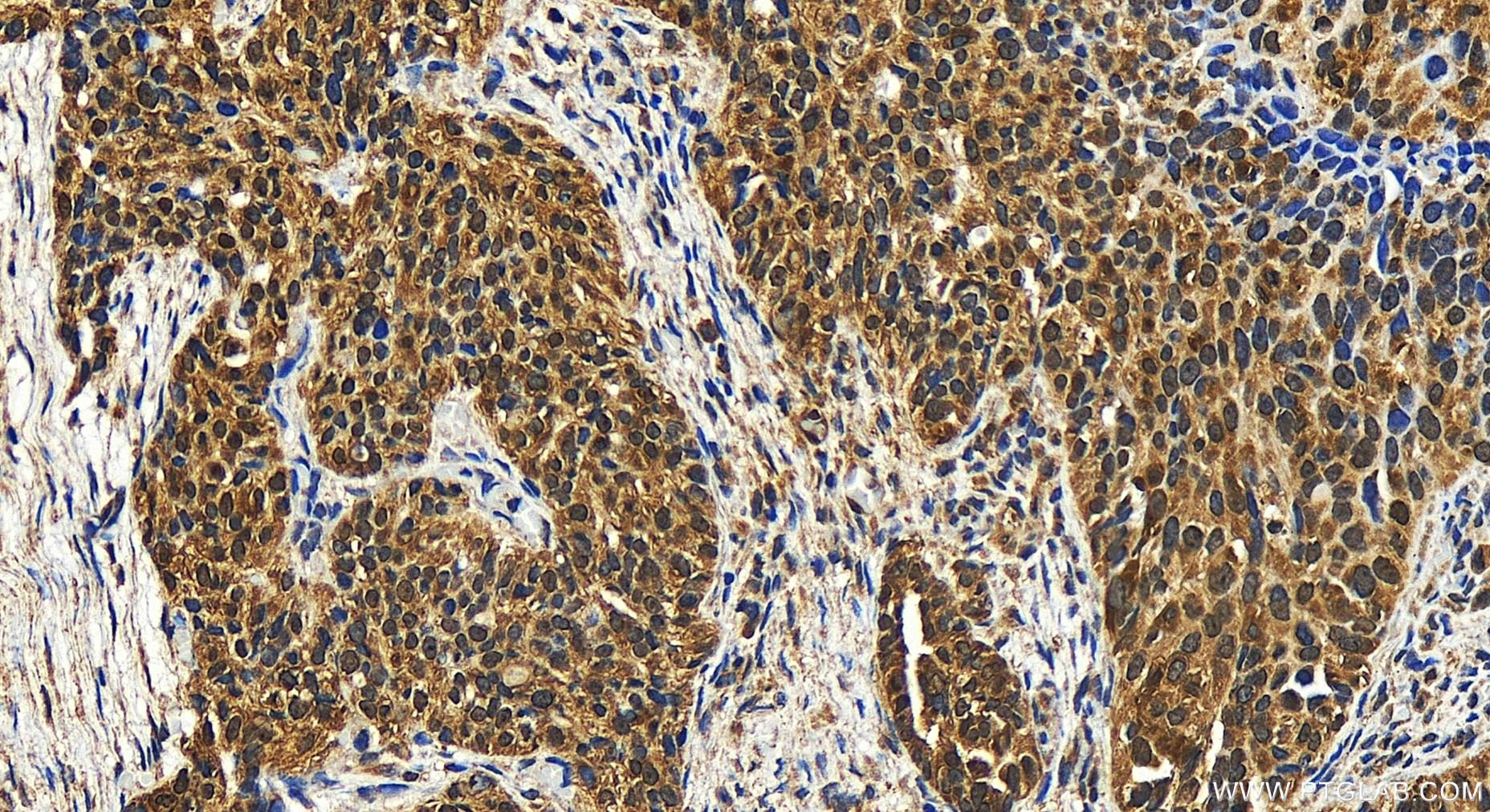 Immunohistochemistry (IHC) staining of human ovary cancer tissue using BYSL Polyclonal antibody (28319-1-AP)