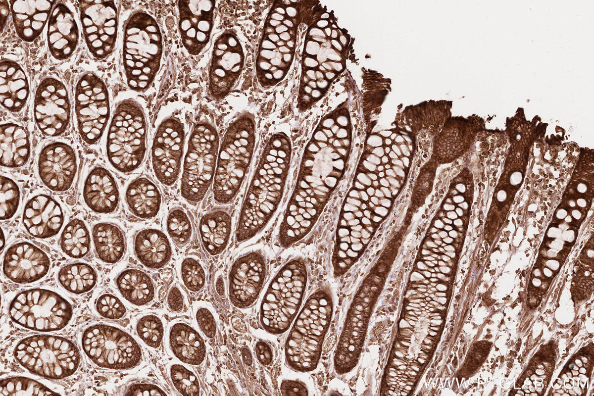Immunohistochemistry (IHC) staining of human rectal cancer tissue using BZW1 Polyclonal antibody (19917-1-AP)