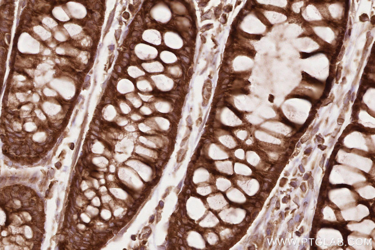 Immunohistochemistry (IHC) staining of human rectal cancer tissue using BZW1 Polyclonal antibody (19917-1-AP)