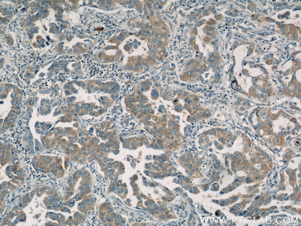 Immunohistochemistry (IHC) staining of human lung cancer tissue using BZW1 Polyclonal antibody (19917-1-AP)