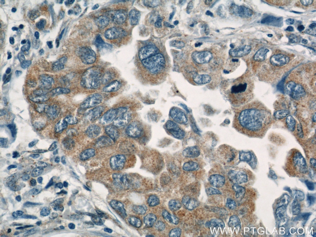 Immunohistochemistry (IHC) staining of human lung cancer tissue using BZW1 Polyclonal antibody (19917-1-AP)