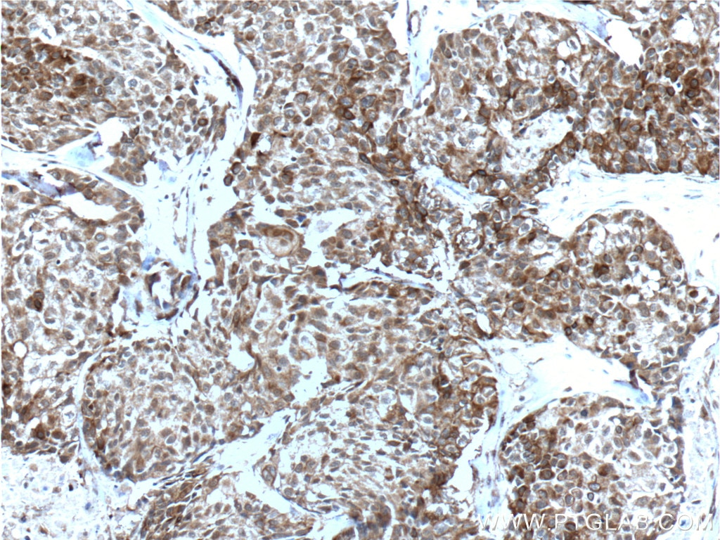 Immunohistochemistry (IHC) staining of human lung cancer tissue using Bcl-XL Polyclonal antibody (10783-1-AP)