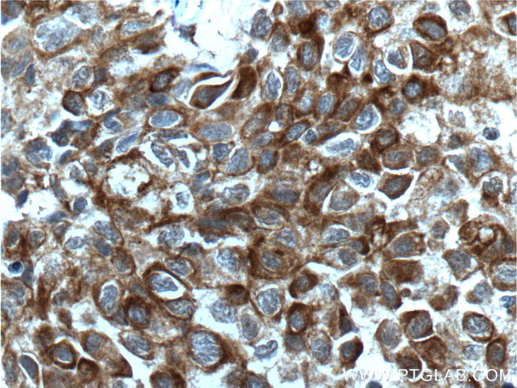 IHC staining of human lung cancer using 10783-1-AP