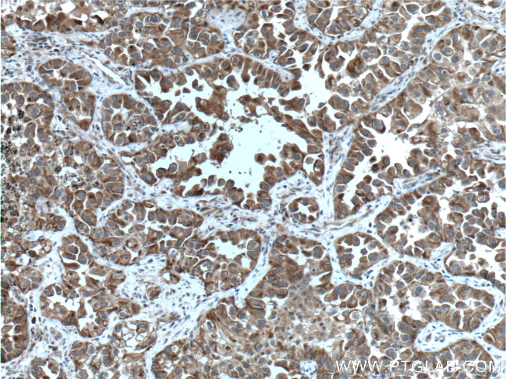 Immunohistochemistry (IHC) staining of human lung cancer tissue using Bcl-XL Polyclonal antibody (26967-1-AP)