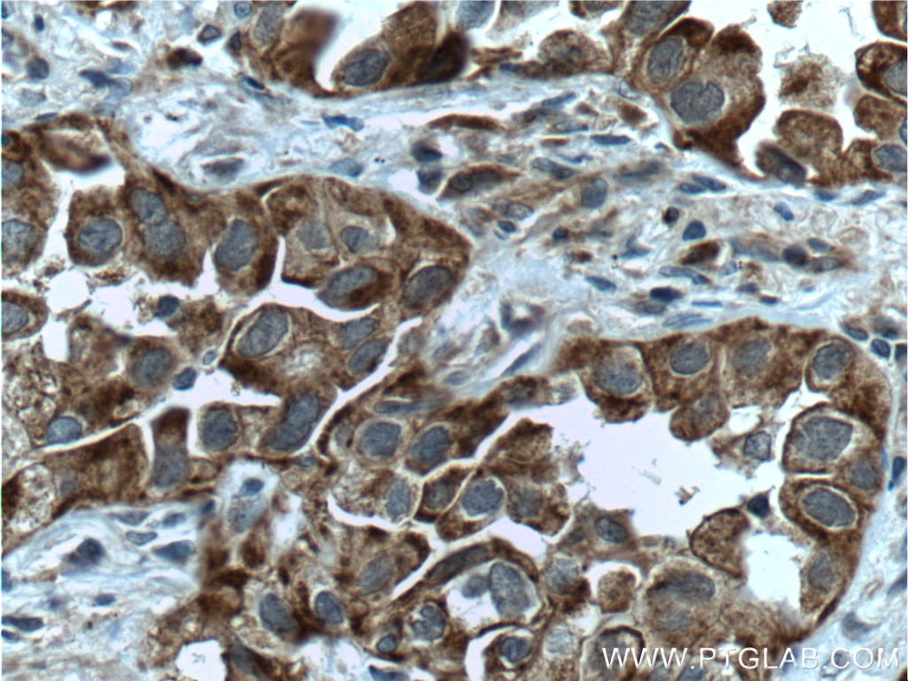Immunohistochemistry (IHC) staining of human lung cancer tissue using Bcl-XL Polyclonal antibody (26967-1-AP)