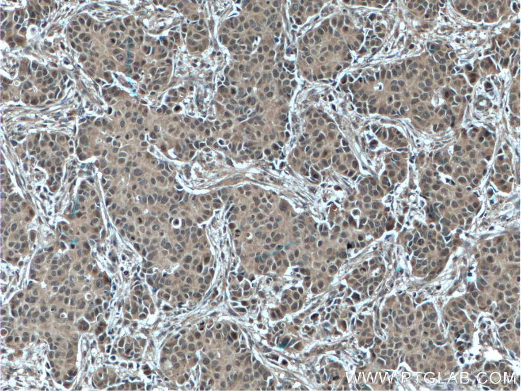 Immunohistochemistry (IHC) staining of human breast cancer tissue using Bcl-XL Monoclonal antibody (66020-1-Ig)
