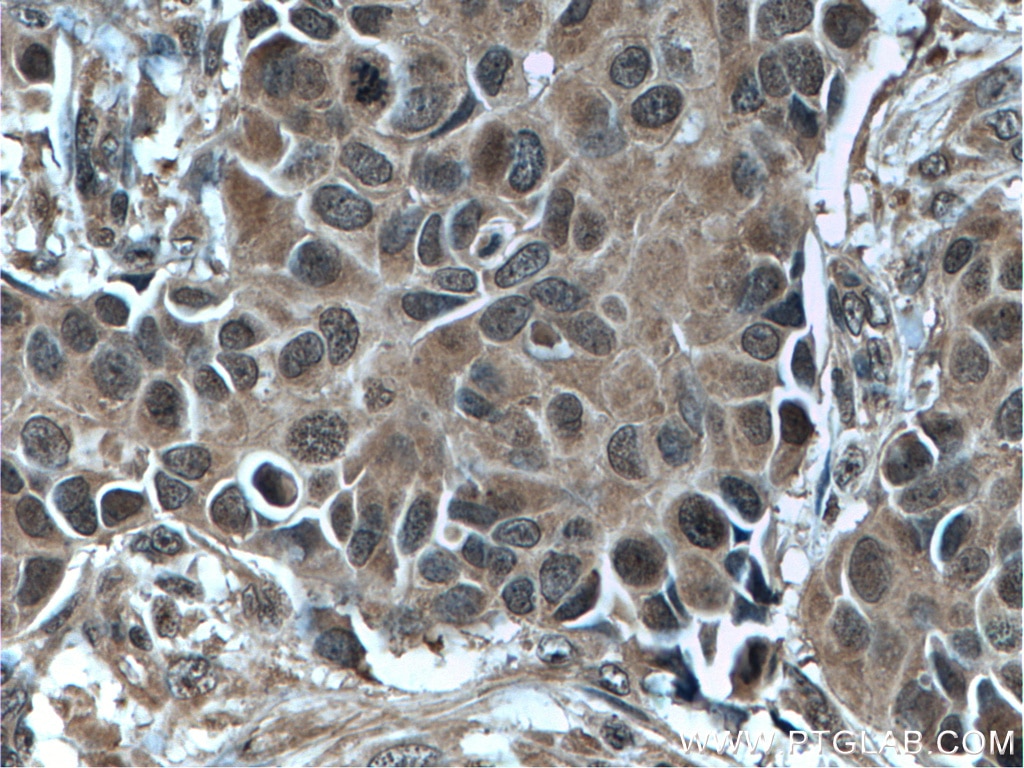 Immunohistochemistry (IHC) staining of human breast cancer tissue using Bcl-XL Monoclonal antibody (66020-1-Ig)