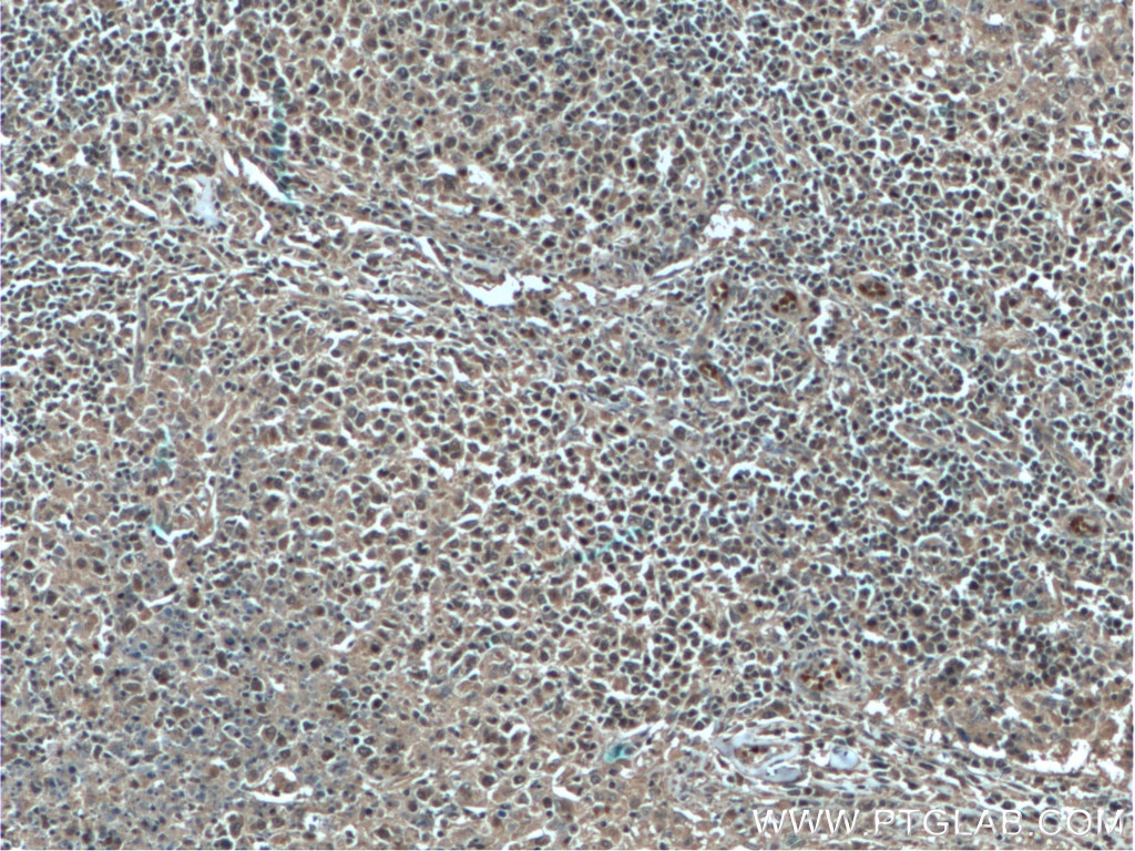 Immunohistochemistry (IHC) staining of human lymphoma tissue using Bcl-XL Monoclonal antibody (66020-1-Ig)