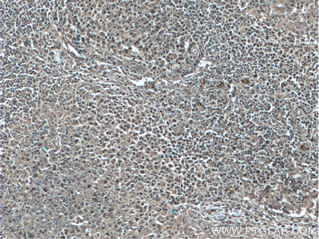 IHC staining of human lymphoma using 66020-1-Ig