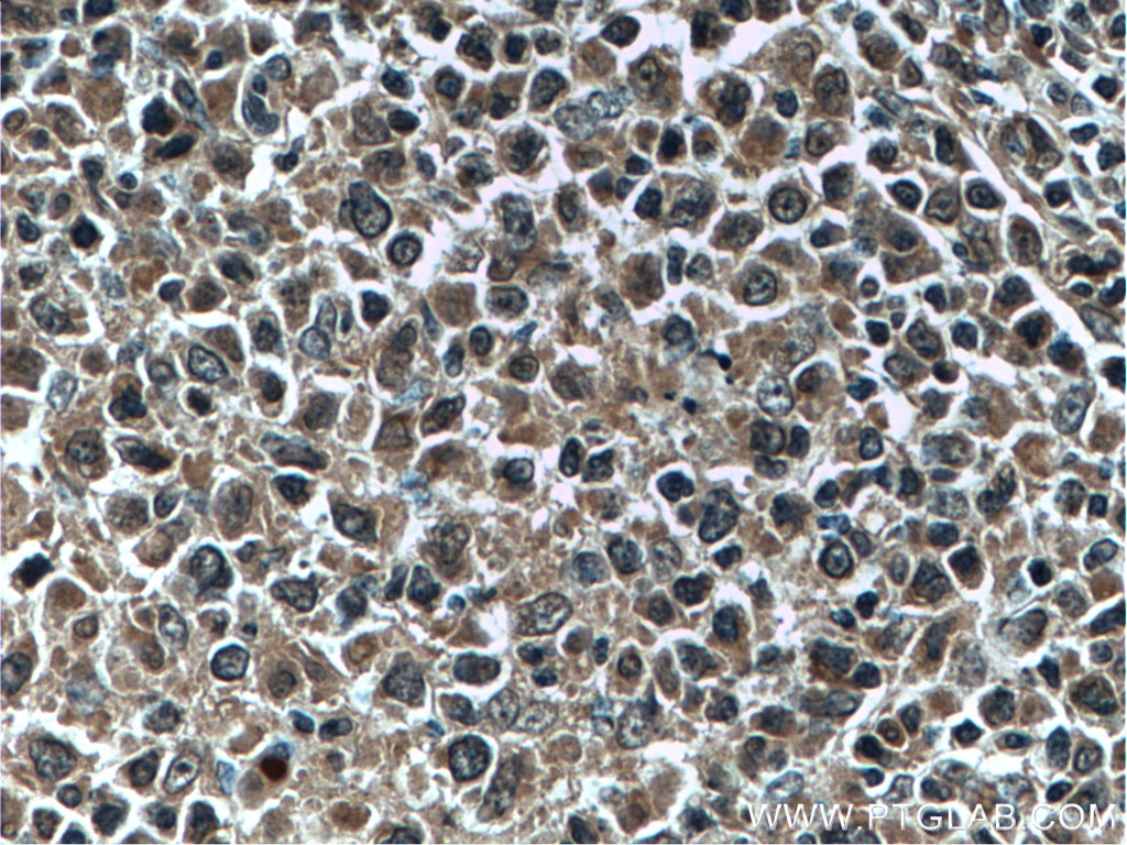 Immunohistochemistry (IHC) staining of human lymphoma tissue using Bcl-XL Monoclonal antibody (66020-1-Ig)