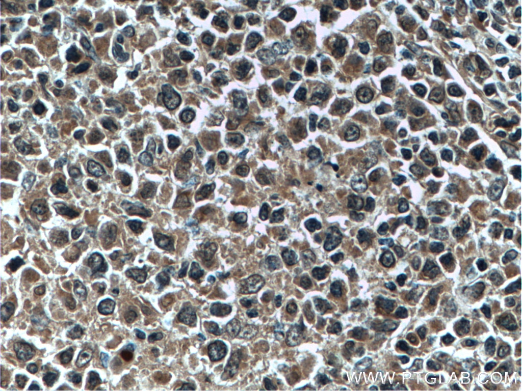 IHC staining of human lymphoma using 66020-1-Ig