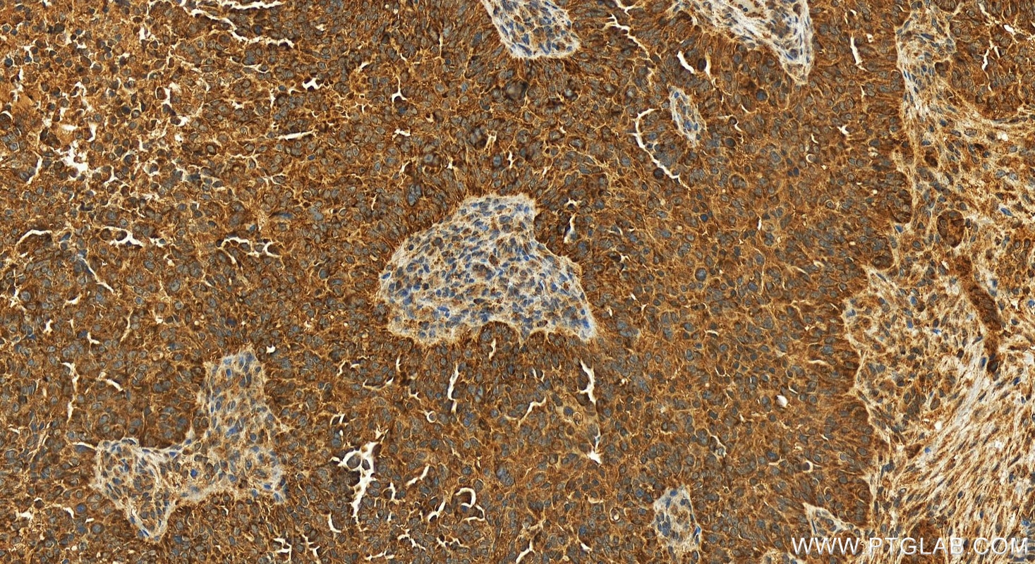 Immunohistochemistry (IHC) staining of human ovarian  cancer using BCL2L1 Recombinant monoclonal antibody (83330-1-RR)