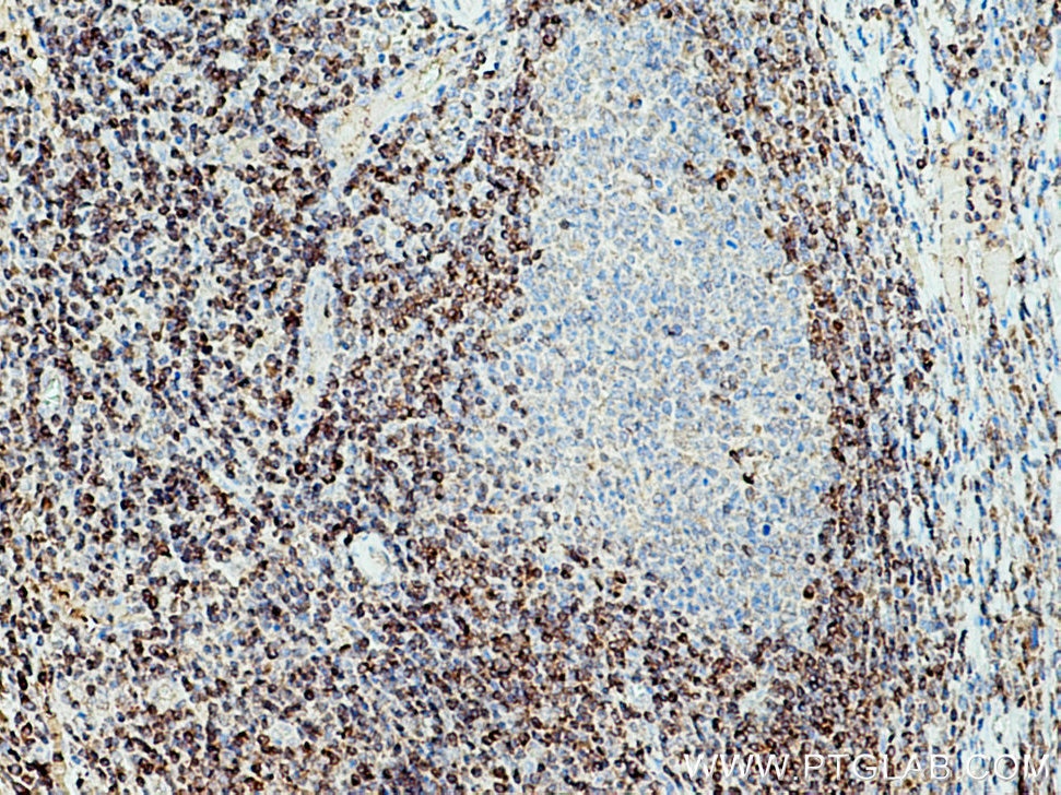 Immunohistochemistry (IHC) staining of human tonsillitis tissue using Bcl2 Polyclonal antibody (26593-1-AP)