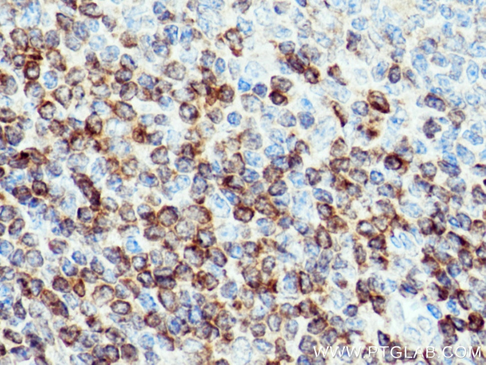 Immunohistochemistry (IHC) staining of human tonsillitis tissue using Bcl2 Polyclonal antibody (26593-1-AP)