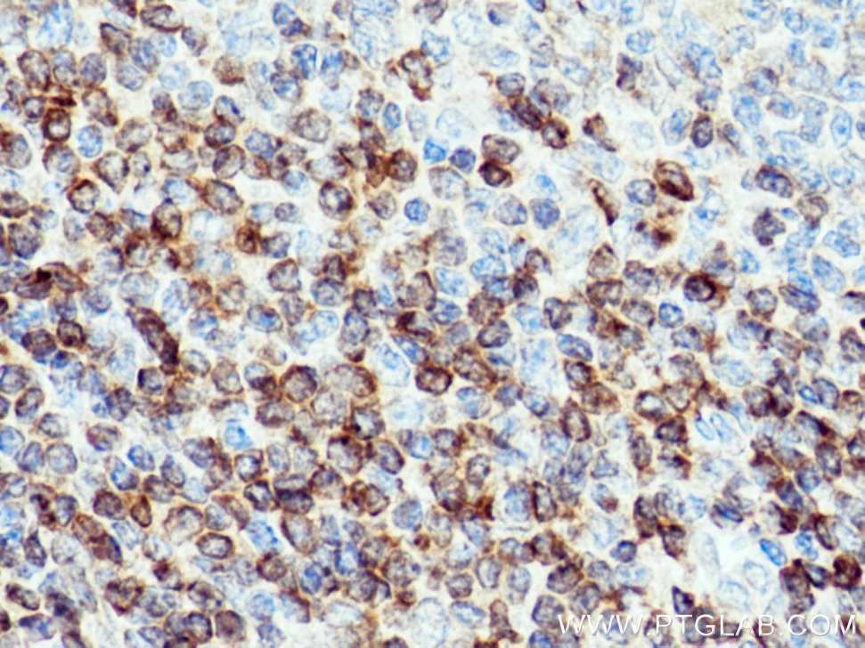 IHC staining of human tonsillitis using 26593-1-AP