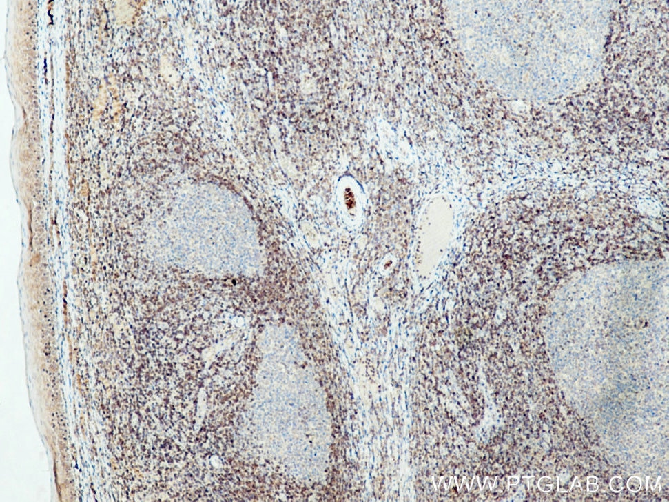 Immunohistochemistry (IHC) staining of human tonsillitis tissue using Bcl2 Polyclonal antibody (26593-1-AP)