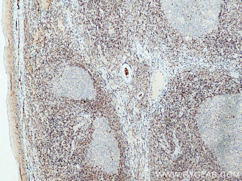 IHC staining of human tonsillitis using 26593-1-AP